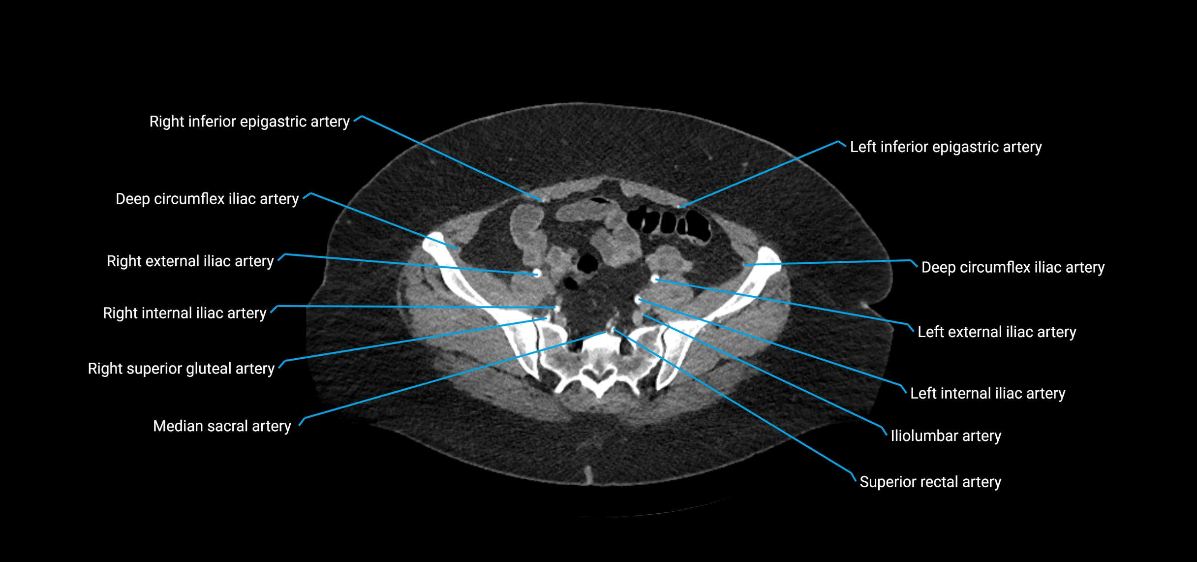 CTA abdomen axial cross sectional anatomy labelled image_196 (2).webp